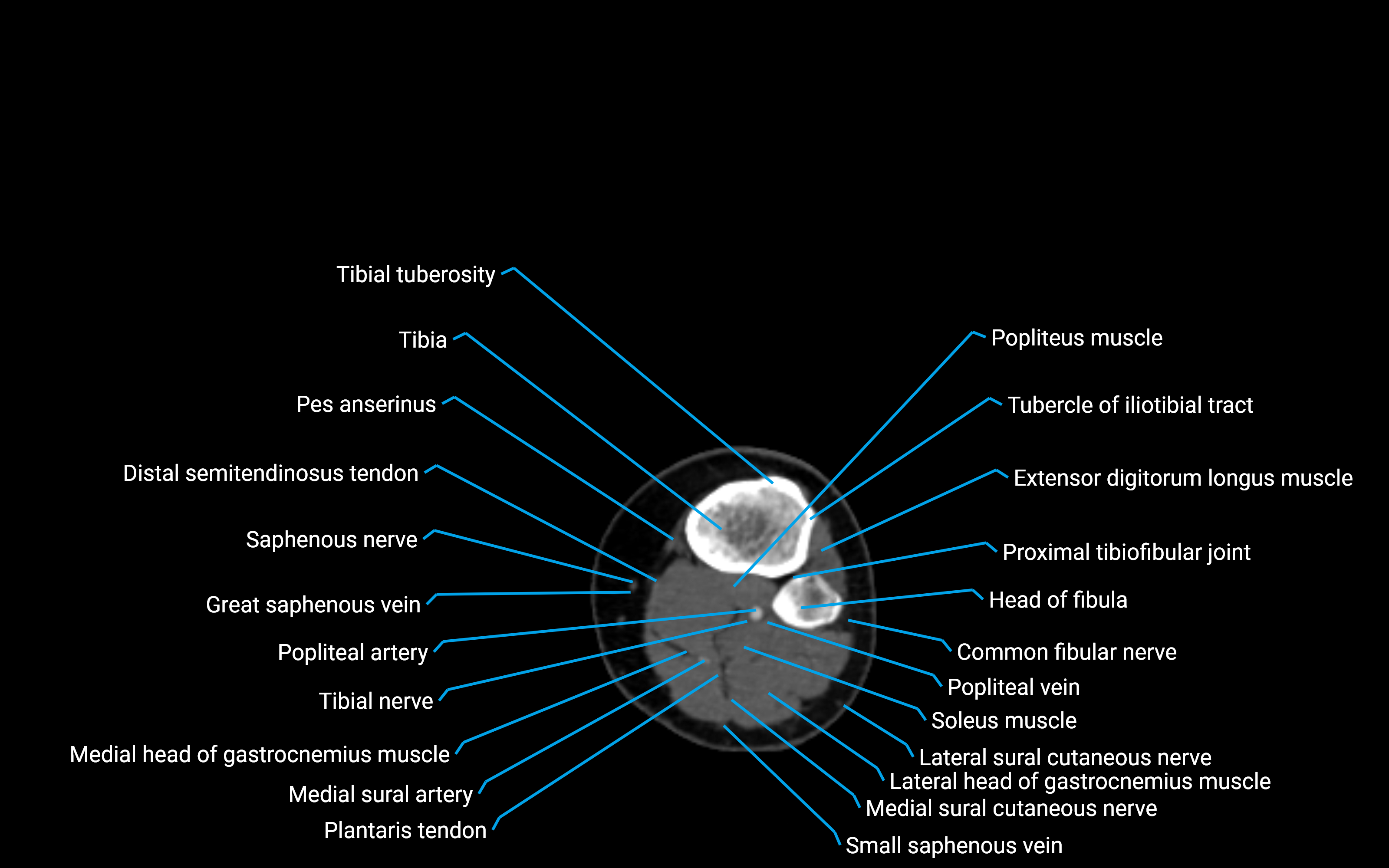 CT Lower leg axial cross sectional anatomy labelled image 97 (2).png
